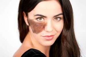 birthmark removal treatment in Pakistan, best skin specialist in lahore, best dermatologist in Dha