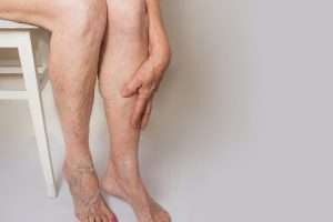 aser treatment for varicose veins in Lahore, aser treatment for leg veins, best skin specialist, best dermatologist in pakistan, best machines for leg veins treatment in dha