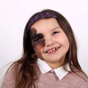 best birthmark removal treatment in Lahore, best skin specialist in Lahore,