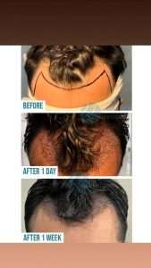 best hair transplant in lahore , best hair transplant surgeon in lahore