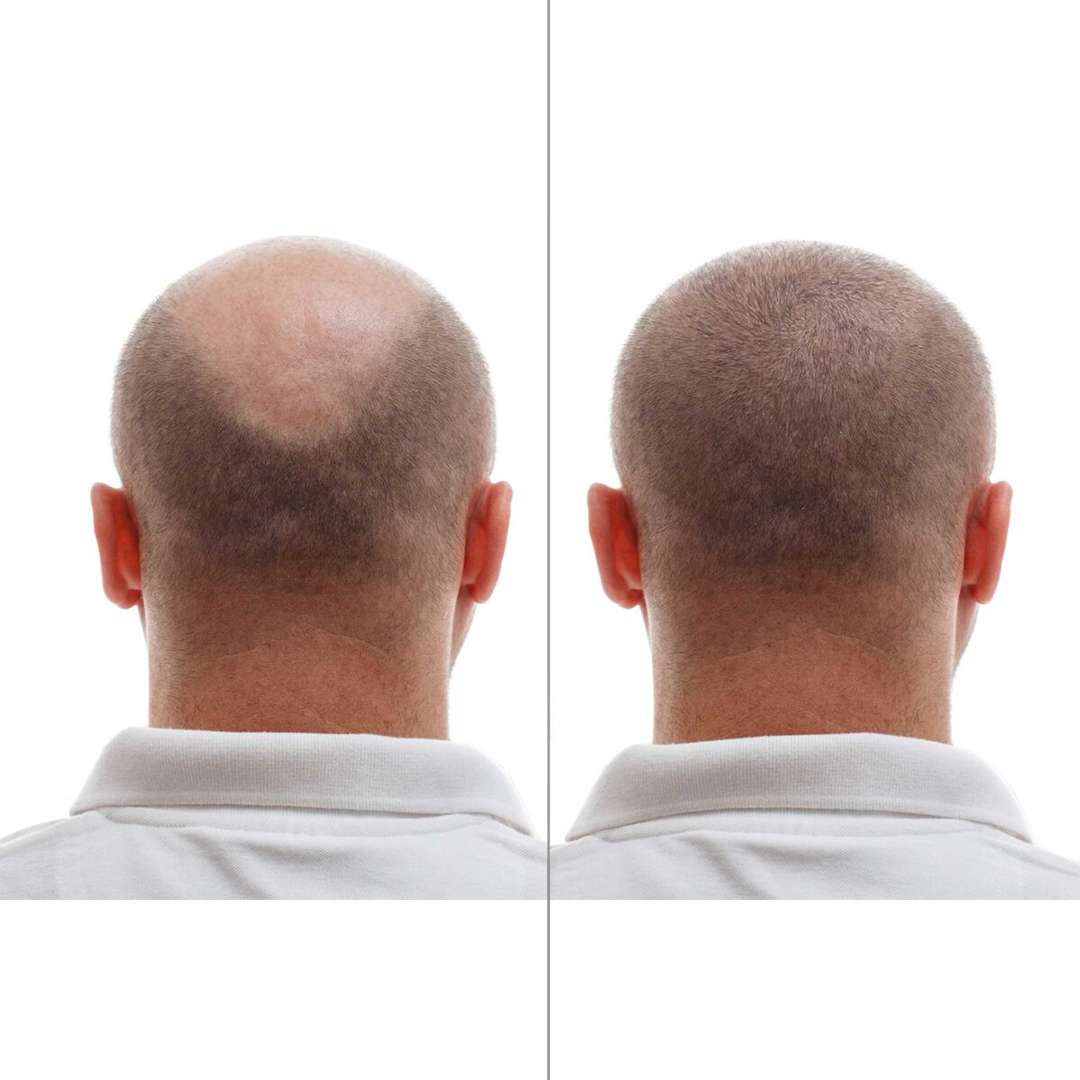 Fut Hair Transplant in Lahore best hair transplant in lahore , best hair transplant surgeon in lahore