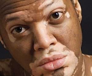 Best Vitiligo Treatment in dha, Lahore Pakistan, best melasma transplant in Lahore