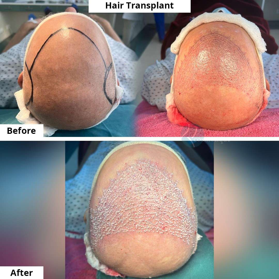 FUE hair transplant in Lahore Best hair transplant in Lahore