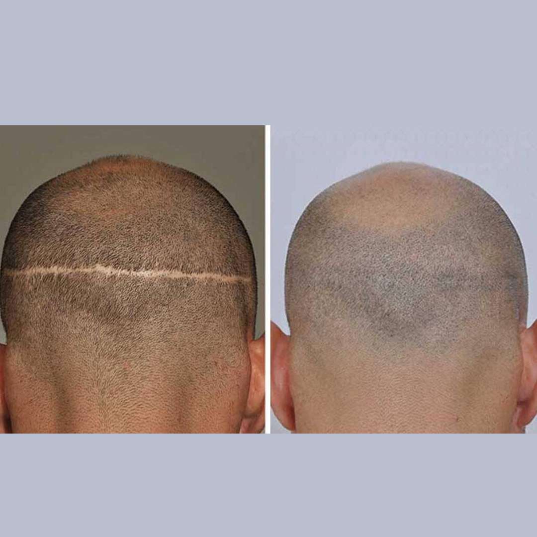 Fut Hair Transplant in Lahore FUT hair transplant in Lahore, best hair transplant in Pakistan, Best hair transplant Surgeon in Lahore