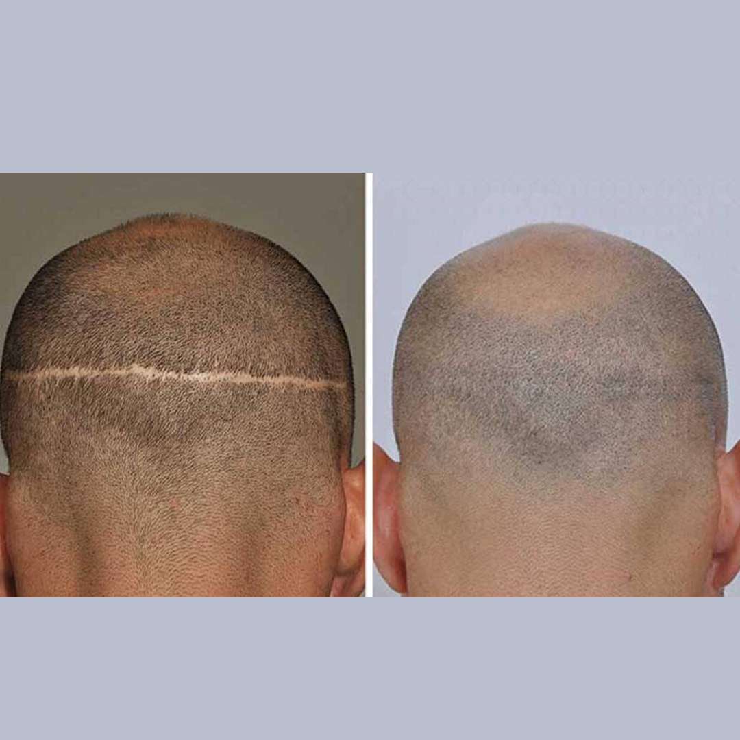 FUT hair transplant in Lahore, best hair transplant in Pakistan, Best hair transplant Surgeon in Lahore