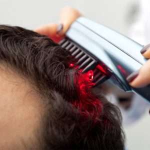 laser therapy for hair loss, Best hair transplant in lahore, Pakistan