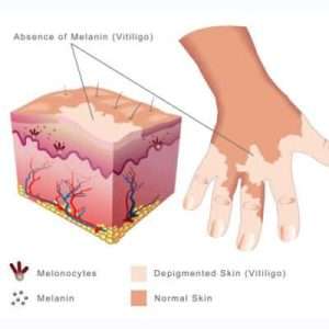 vitiligo-treatment in Lahore at cosmetique clinic