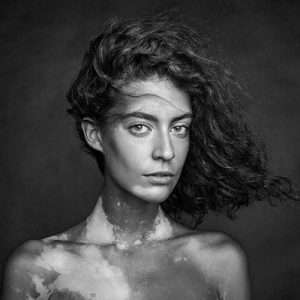 vitiligo treatment in MM ALam, best doctor for Melanocyte transplant in lahore