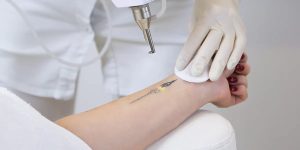 best Tattoo removal treatment in Lahore, best Laser treatment for tattoo removal in MM Alam