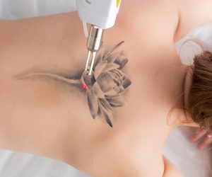 best laser treatment for tattoo removal in Lahore, best tattoo removal treatment in MM Alam branch