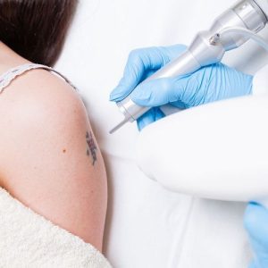 best laser tattoo removal treatment in lahore, best laser treatment for tattoo removal treatment in MM Alam