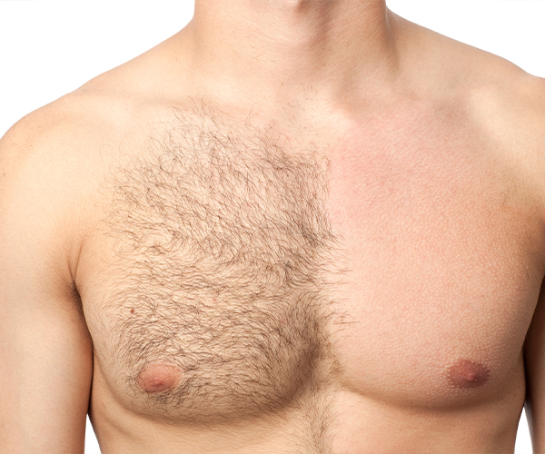 laser hair removal for men