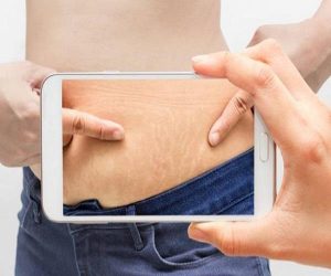 Strach marks removal treatment in Lahore, skin damage treatment in Lahore