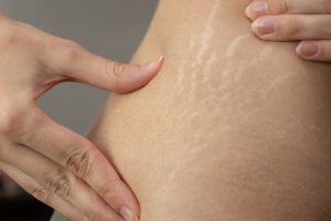 Young woman showing stretch marks on her body, best stretch marks removal in Lahore