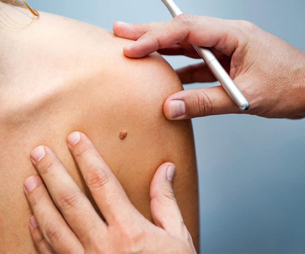 best mole removal treatment in Lahore