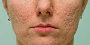 best-scars-removal-treatment-in-lahore